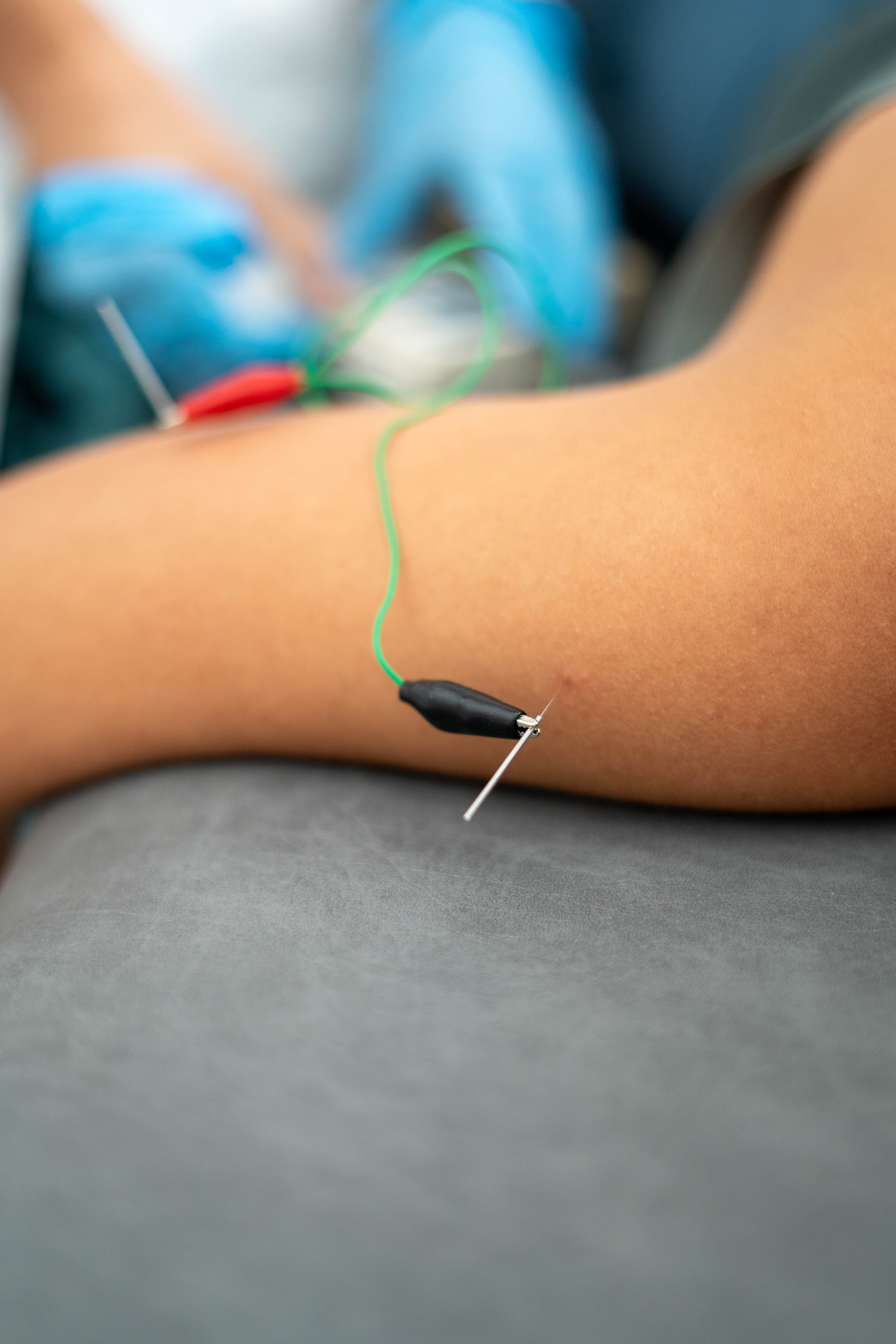 shallow-focus-shot-of-a-woman-with-acupuncture-nee-2025-02-09-01-54-49-utc
